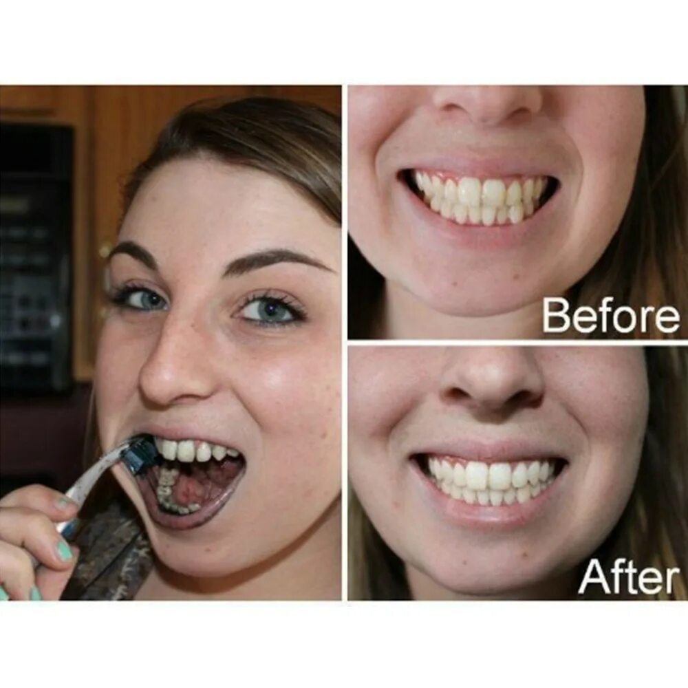 Можно курить после стоматолога. Отбеливание зубов углем до и после. Отбеливание зубов углем. Отбеливание зубов активированным углем.