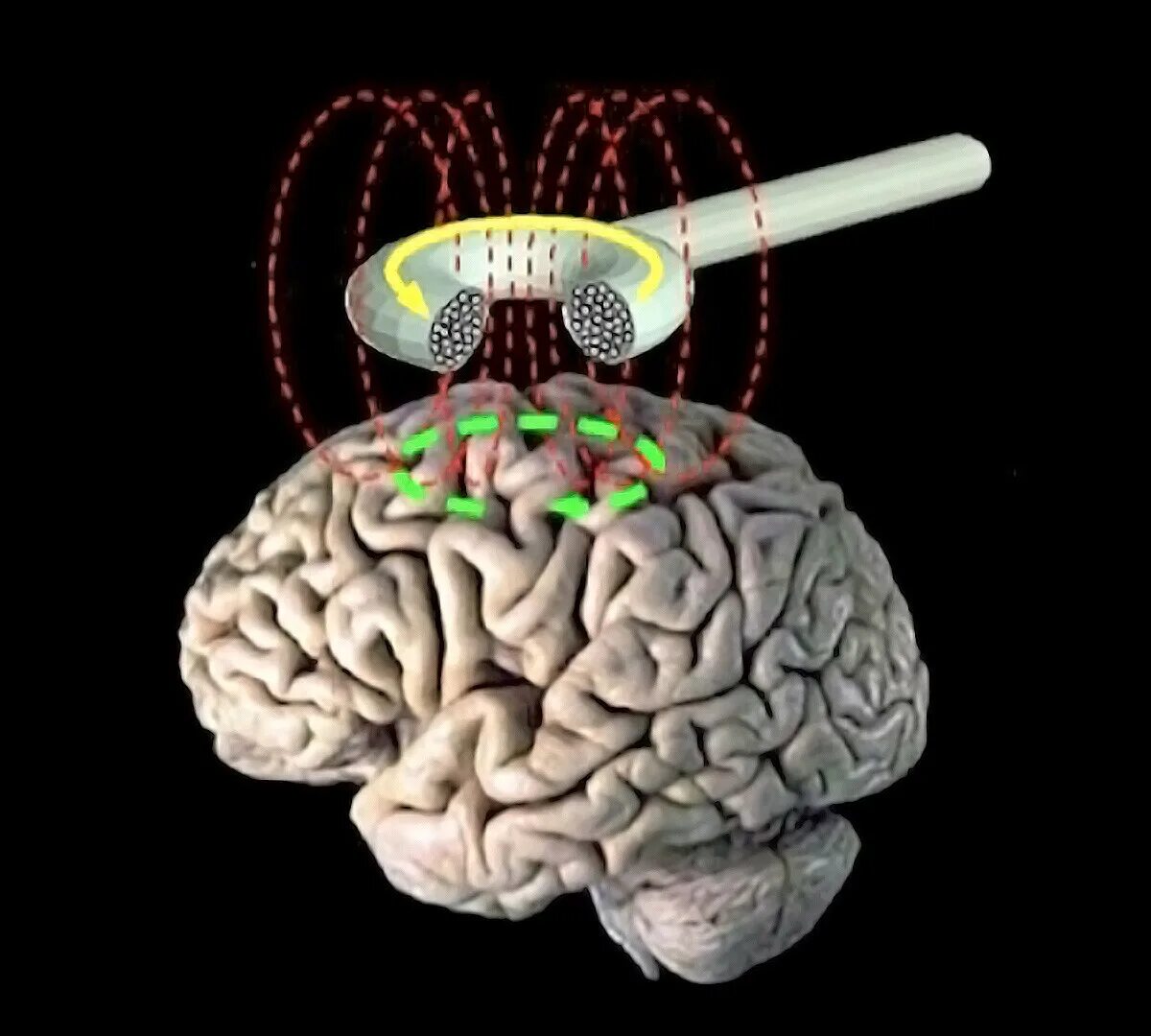 Мозг магнитное поле. Транскраниальная магнитная стимуляция головного мозга. Магнитная стимуляция ТМС. ТМС транскраниальная магнитная стимуляция. Транскраниальная магнитная стимуляция (ТМС)– аппарат.