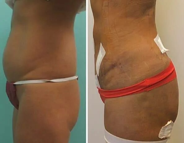Периумбиликальная миниабдоминопластика. Живот после липосакции. Zeltiq криолиполиз. Аппарат вайзер липосакция. Лазерная липосакция боков.