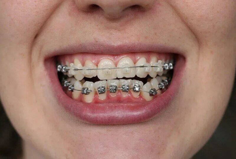 брекеты на обеих челюстях