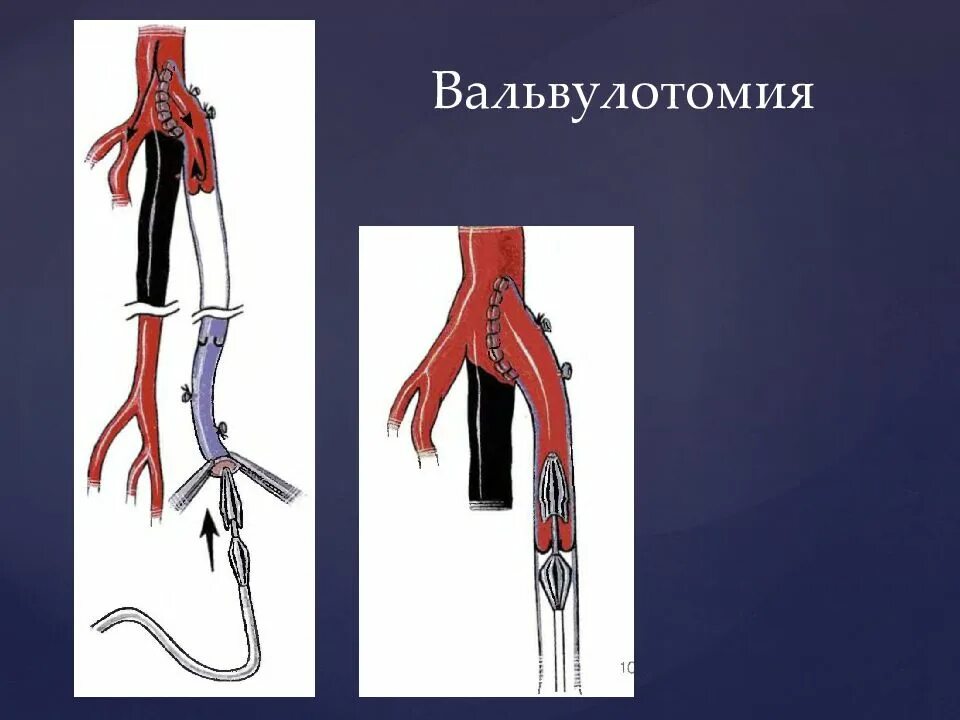 Операция шунтирование нижних. Реваскуляризация артерий нижних конечностей. Шунтирование подвздошной артерии. Протезирование подвздошной артерии. Реваскуляризация конечности.