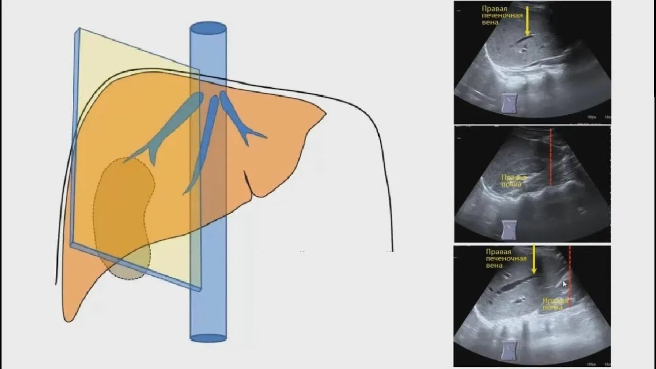 Плоскости сканирования печени при УЗИ. Ультразвуковая анатомия печени сегменты. Продольное сканирование печени на УЗИ. Сегменты печени УЗИ анатомия. Узи печени схема