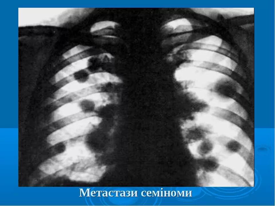 Метастазы в легких что это. Солитарная туберкулема. семинома метастазы в легких. туберкулема рентген. метастазы семиномы в легкие..