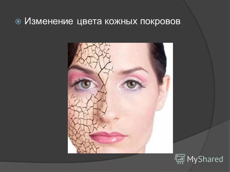 Синдром диабетической стопы. Кожные покровы пропедевтика внутренних болезней. Первичные полостные морфологические элементы сыпи. Возрастные изменения кожи лица. Шиперемия кожных покрово.