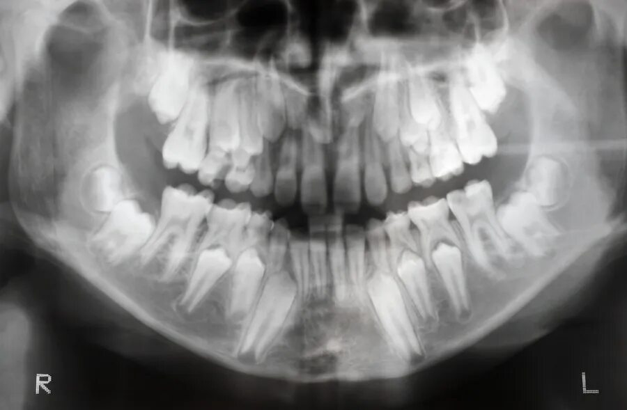 Детский череп фото. Экзостоз кости челюсти. Смена молочных зубов у детей рентген. Экзостоз верхней челюсти рентген. Снимок черепа ребенка с зубами.