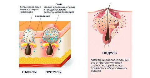 Стадии прыща