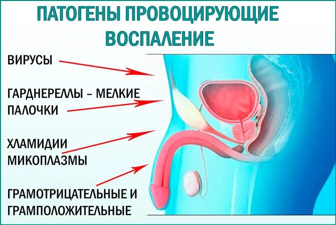 Острые простаты. Острый и хронический простатит. Хронический простатит.