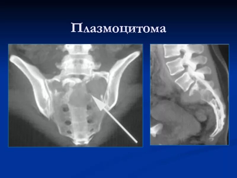 Солитарная плазмоцитома кости кт. Множественная миелома симптомы. Плазмоцитома позвонка на кт. Характерные проявления миеломной болезни. Солитарная плазмоцитома.