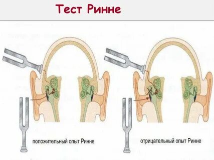 Ринне вебера