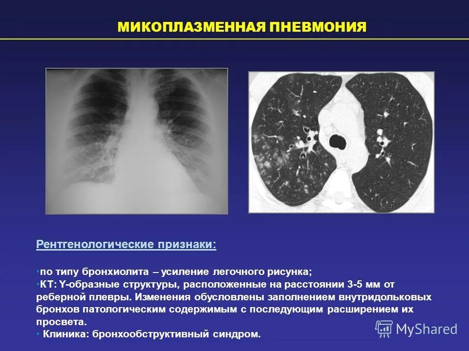 Микоплазменная пневмония симптомы у взрослых лечение. Рентгенологическая картина микоплазменной пневмонии. микоплазма пневмония рентген. микоплазма пневмония кт. признаки микоплазменной пневмонии.