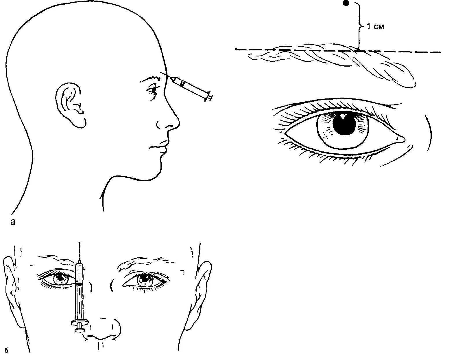 Ботокс схема введения. Схема введения ботулотоксина. Ботокс техника введения. Схема введения ботулотоксина для поднятия бровей. Точка уколова