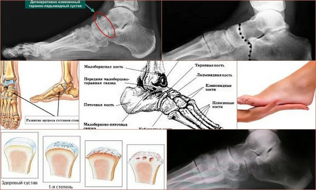 Остеоартроз 1 плюснефалангового сустава рентген. Остеоартроз 1 плюснефалангового сустава рентген. Артроз суставов стоп 2 степени. Деформирующий артроз таранно-ладьевидного сустава. Остеоартроз первого плюснефалангового сустава 1-2.