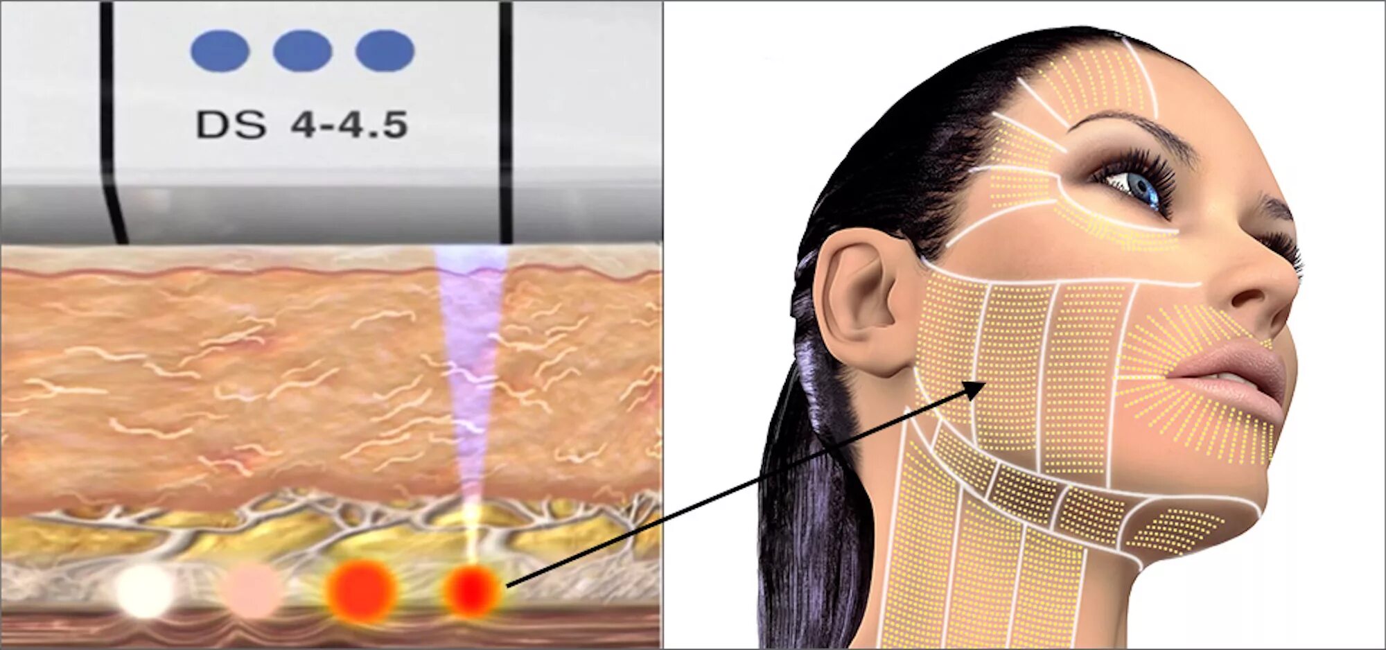 Smas лифтинг цена skinlift ru. Аппарат смас лифтинг HIFU. HIFU 7d аппарат смас лифтинг. Смас лифтинг Альтера.