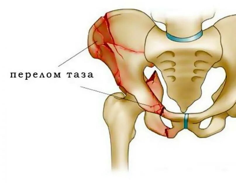 Берцовая и подвздошная кость. Перелом таза и тазобедренной кости. Лонная кость таза перелом. Лонная кость тазобедренного сустава. Подвздошная кость таза перелом.