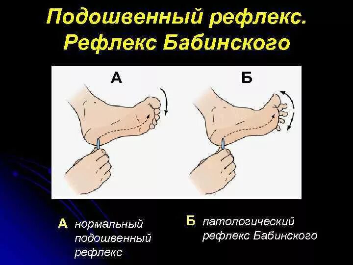 Спонтанный рефлекс Бабинского. Рефлекс Бабинского патология. Пирамидный симптом Бабинского. Аномальный рефлекс Бабинского.