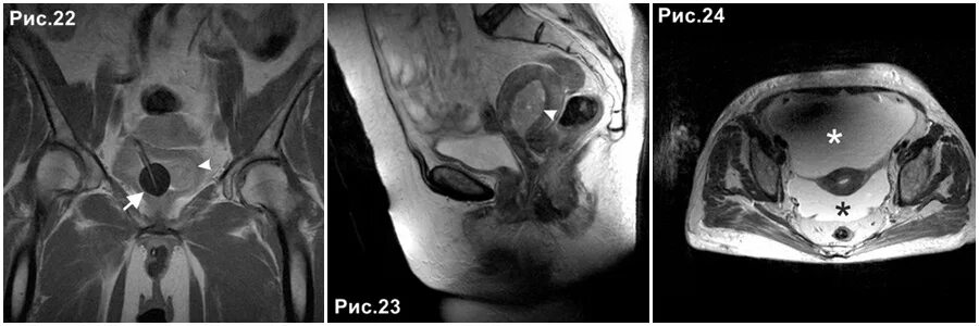 мрт бедренной кости и тазобедренного сустава. опухоли предстательной железы мрт. перелом тазобедренный сустав кт. опухоль таза. тератома мрт малый таз.