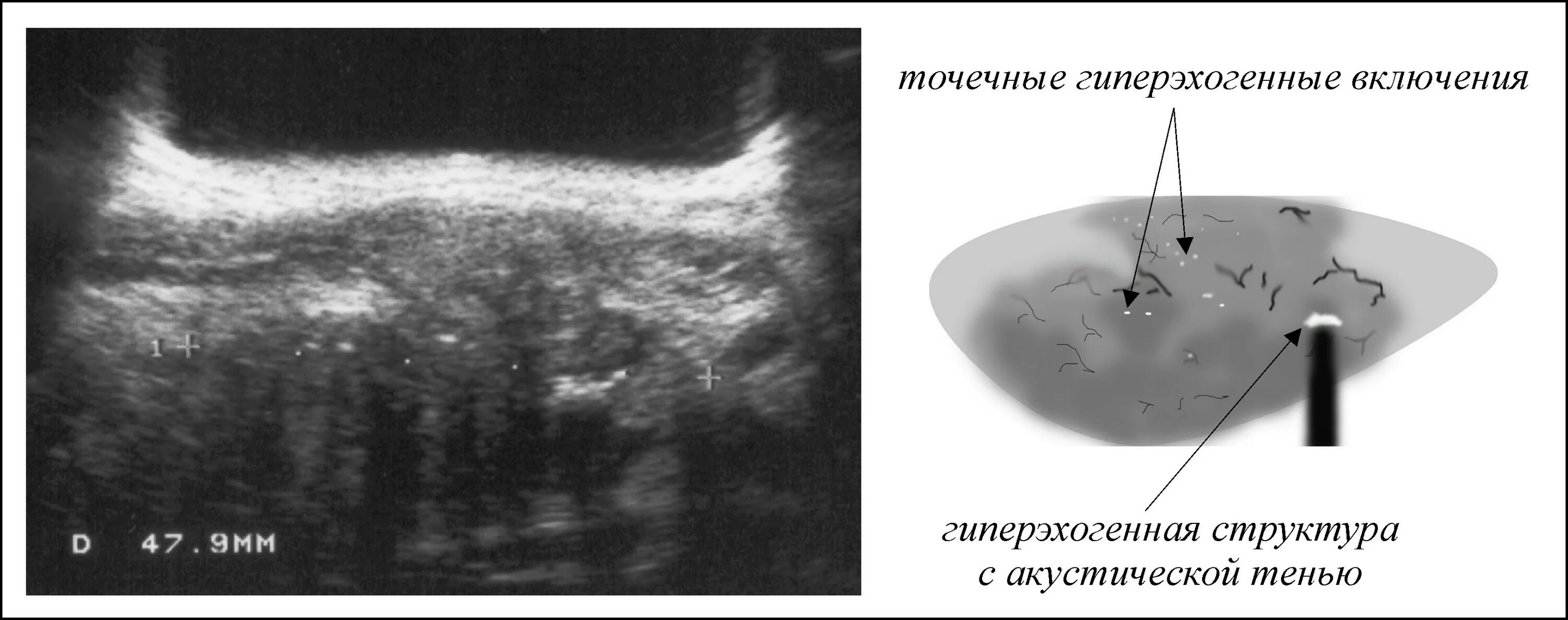 Эхогенность селезенки. Гиперэхогенная структура на УЗИ. Гиперэхогенные линейные структуры. Гиперэхогенные структуры на УЗИ печени. Гиперэхогенное образование без акустической тени.