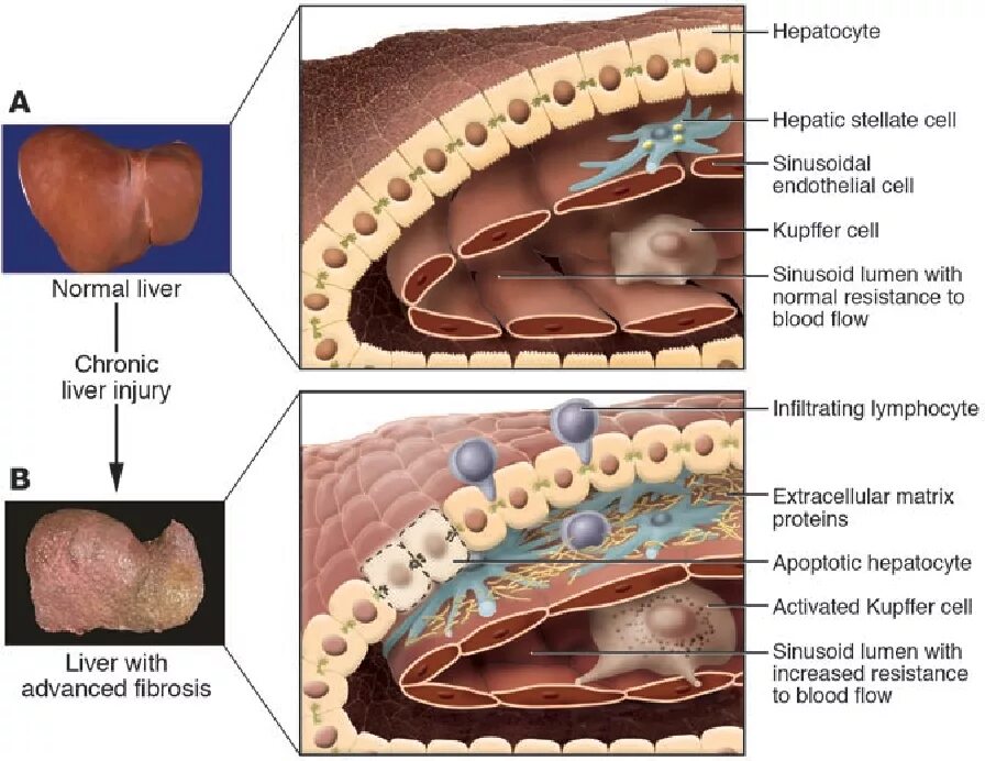 Повреждение клеток печени. Механизм развития фиброза печени. Патогенез фиброза печени. Перицеллюлярный фиброз. Фиброз печени этиология.