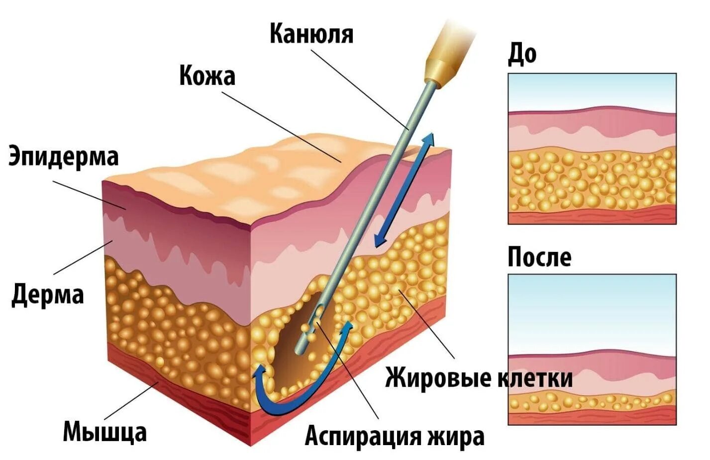 Как называется удаление жира