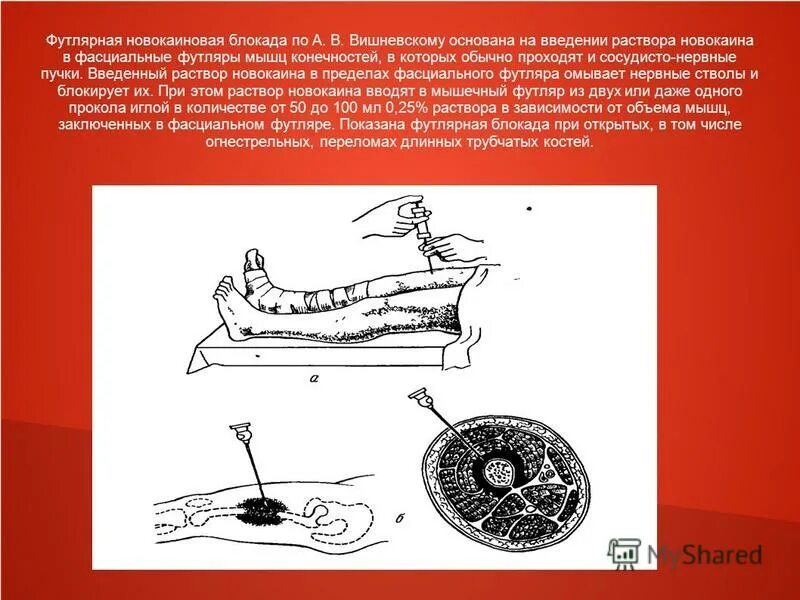 Вагосимпатическая блокада по вишневскому