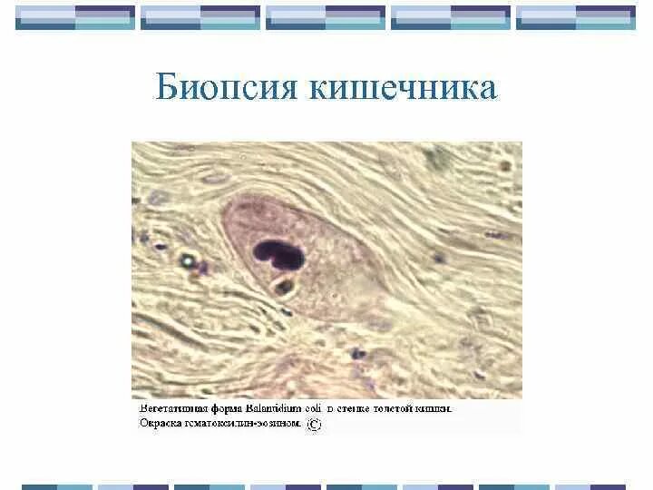 Биоптат кишки. Биопсия Толстого кишечника. Биопсия тонкого кишечника. Показания к биопсии кишечника. Биопсия ворсинок кишечника.