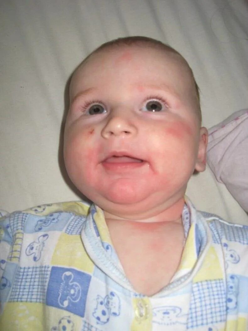 Аллергия у новорожденного на лице. Высыпания на лице у грудничка. Высыпания на лице у новорожденного.