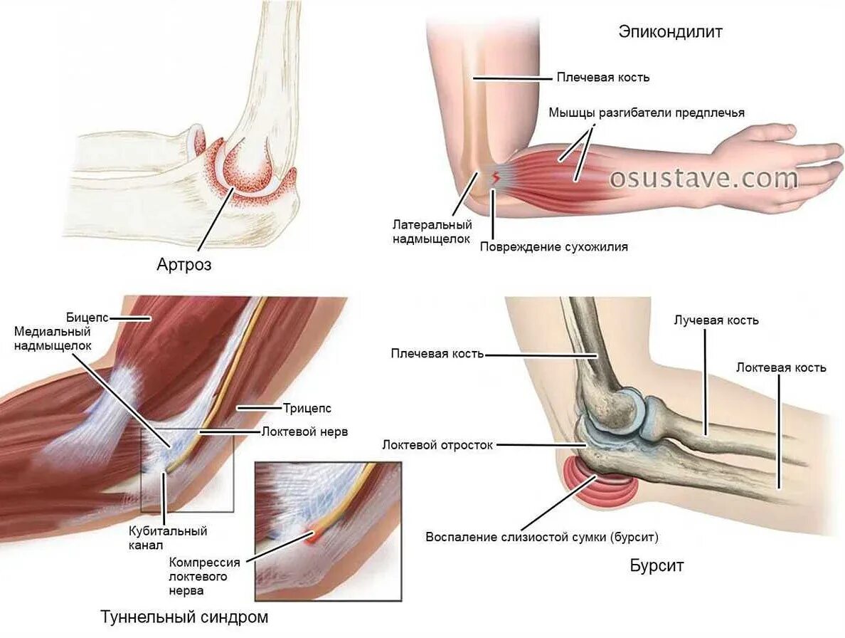 Лечение предплечья. Болят кости руки сбоку локтя. Локоть сустав болит косточка сбоку. Латеральный эпикондилит сухожилие.