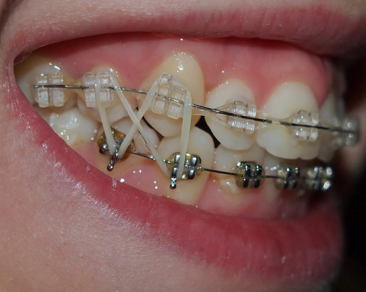 Ортодонтия что это. Брекеты межчелюстные эластики. Кросс эластики ортодонтия. Ортодонтические эластики 3/16" 3,5.
