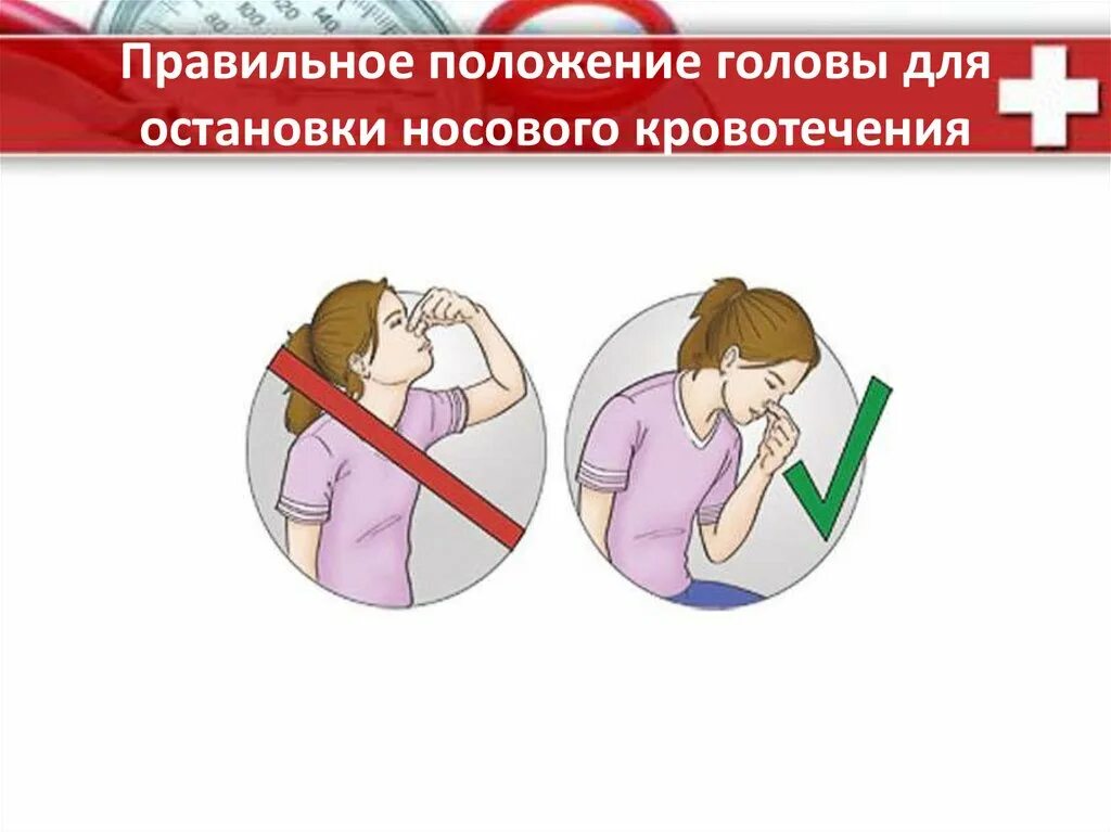 Какое положение при носовом кровотечении. Правильное положение головы для остановки носового кровотечения. Способы остановки кровотечения из носа. Методика остановки носового кровотечения. Способы остановки носового кровотечения.