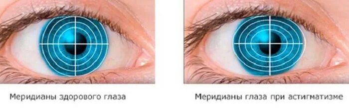 Меридиана глаза это. Зрительная ось глазного яблока. Меридиана глаза это. Меридиана глаза это. Меридианы глаза при астигматизме.