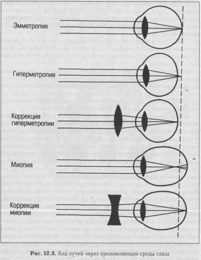 Преломляющие среды глаза. Эмметропия миопия гиперметропия. миопия ход лучей. миопия схема преломления лучей. механизмы глаза, обеспечивающие ясное зрение в различных условиях.