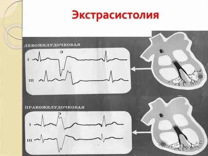 Экстрасистолия опасна для жизни