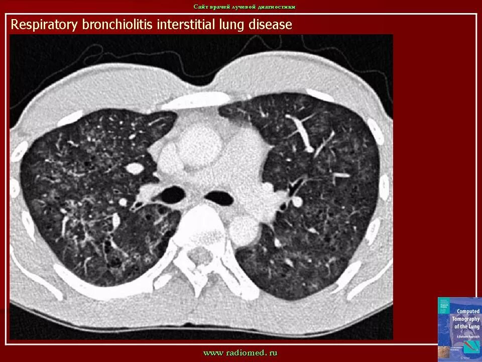 Дерева в почках в легких кт. Облитерирующего бронхиолита кт. Респираторный бронхиолит кт картина. Туберкулезный бронхиолит на кт. Хронический бронхиолит на кт.