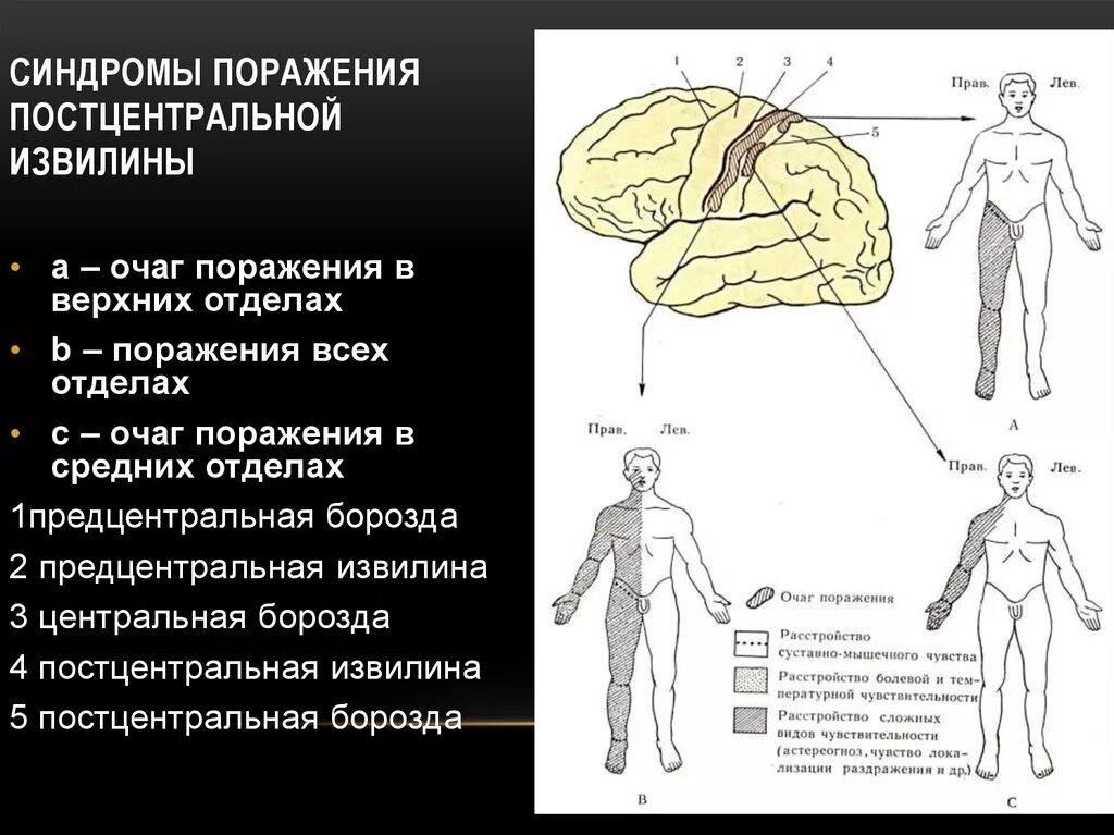 Двигательные симптомы поражения. Поражение постцентральной извилины. Прецентральная извилина поражение. Синдромы поражения центральных извилин. Поражение прецентральной извилины симптомы.