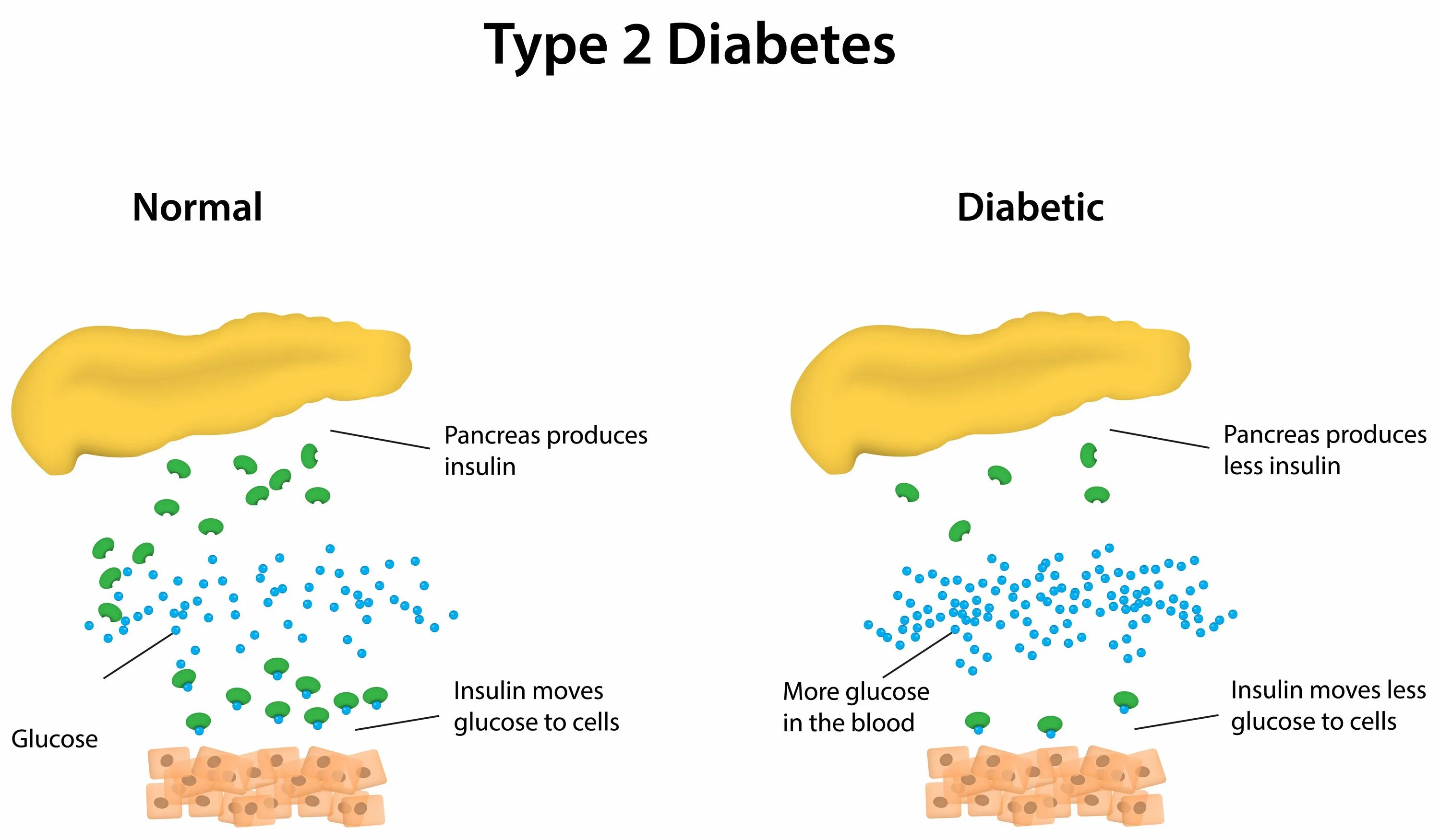 Сахарный диабет 2 типа виды. Диабет 2 типа. Type 2 Diabetes. Типы сахарного диабета.