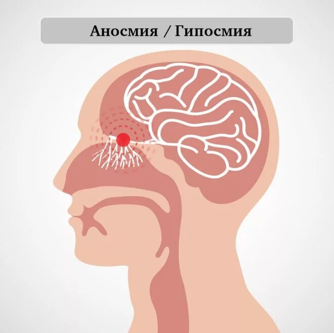 Потеря обоняния. Аносмия (потеря обоняния). Обонятельная аносмия. Аносмия и гипосмия.