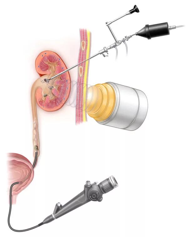 Как дробят камни в мочеточнике. Эндоскопическая трансуретральная литотрипсия. Контактная литотрипсия камней мочеточника. Литотрипсия камней в мочеточнике. Трансуретральная литотрипсия камней почек.