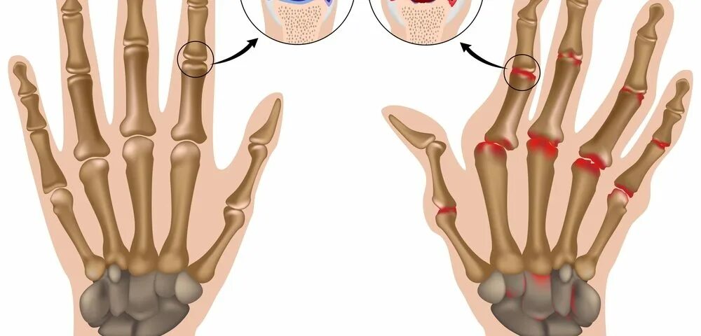 Остеоартроз лучезапястного сустава кисти. Ревматоидный артрит лучезапястного сустава. Фаланга ревматоидный артрит. Артрит лучезапястного сустава мкб. Артрит межфаланговых