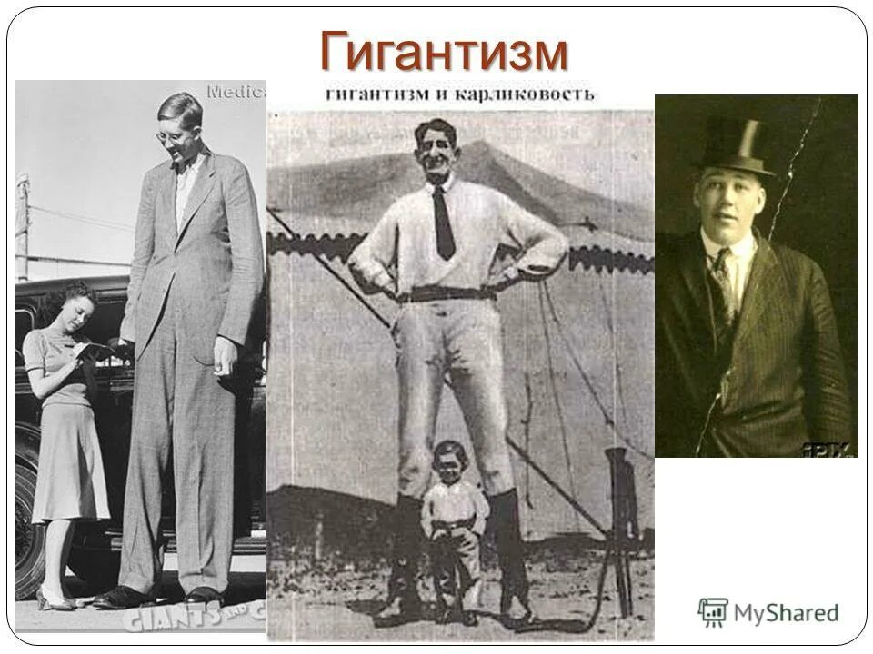 Соматотропный гормон гигантизм. Заболевание при избытке соматотропина. Карликовость развивается при гипофункции. Изменения, возникающие при гипо- и гиперфункции гипофиза. Болезни при нарушении гормона роста.