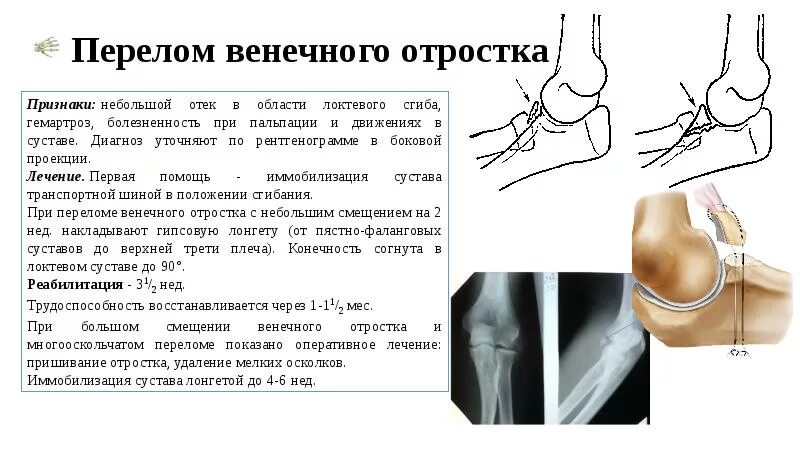 Перелом венечного отростка локтевой. Перелом венечного отростка локтевой кости. Остеосинтез венечного отростка. Перелом венечного отростка локтевого сустава.