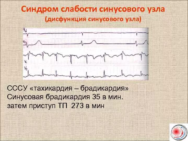 Дисфункция синусового узла что это. Синдром слабости синоатриального узла ЭКГ. Синдром слабости са узла ЭКГ. Синдром слабости синусового узла ЭКГ признаки. ЭКГ критерии дисфункции синусового узла.