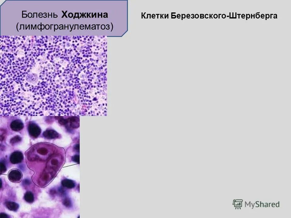 Клетки рида. Клетки Рид-Березовского-Штернберга. Гигантские многоядерные клетки Рид-Березовского-Штернберга.. Лимфома Ходжкина клетки Березовского-Штернберга-Рид. Лимфогранулематоз гистология клетки Березовского Штернберга.