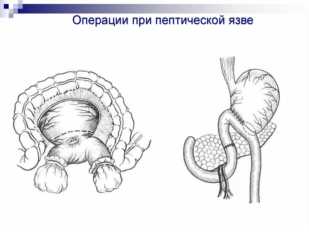 Пептическая язва анастомоза. Пептическая язва гастроэнтероанастомоза. Пептическая язва анастомоза диагностика. Пептическая язва анастомоза причины. Анастомозит что это