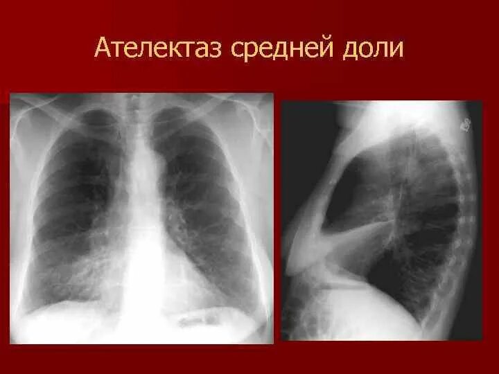 Субсегментарный ателектаз. Дисковидный ателектаз рентген. 4. ателектаз.. ателектаз нижней доли правого легкого рентген. ателектаз верхней доли левого легкого кт.