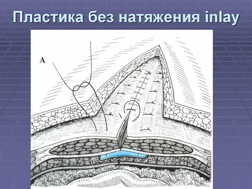 Сетка при удалении грыжи. Inlay пластика грыжи. грыжесечение sublay пластика. аллопластика грыжи sublay. пластика грыжи sublay техника.