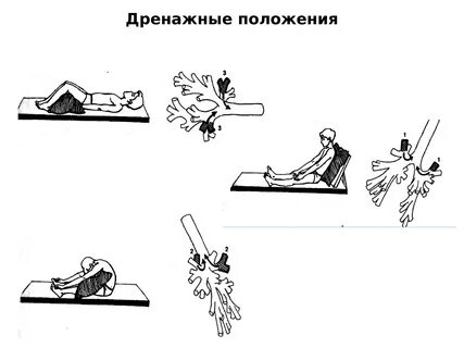 Постуральный дренаж положения
