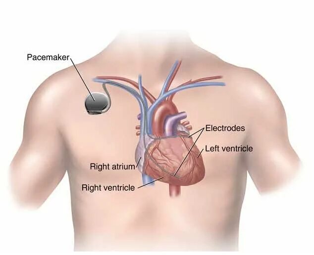 Если стоит кардиостимулятор можно. Электрокардиостимулятор. Установленный кардиостимулятор. Аппарат для сердца кардиостимулятор.