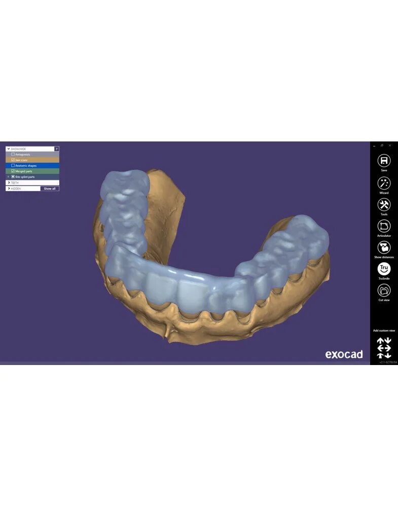 Cad cam моделирование. Каппа сплинт cad cam. exocad каппа. каппа бынина. моделировка каппы бынина.