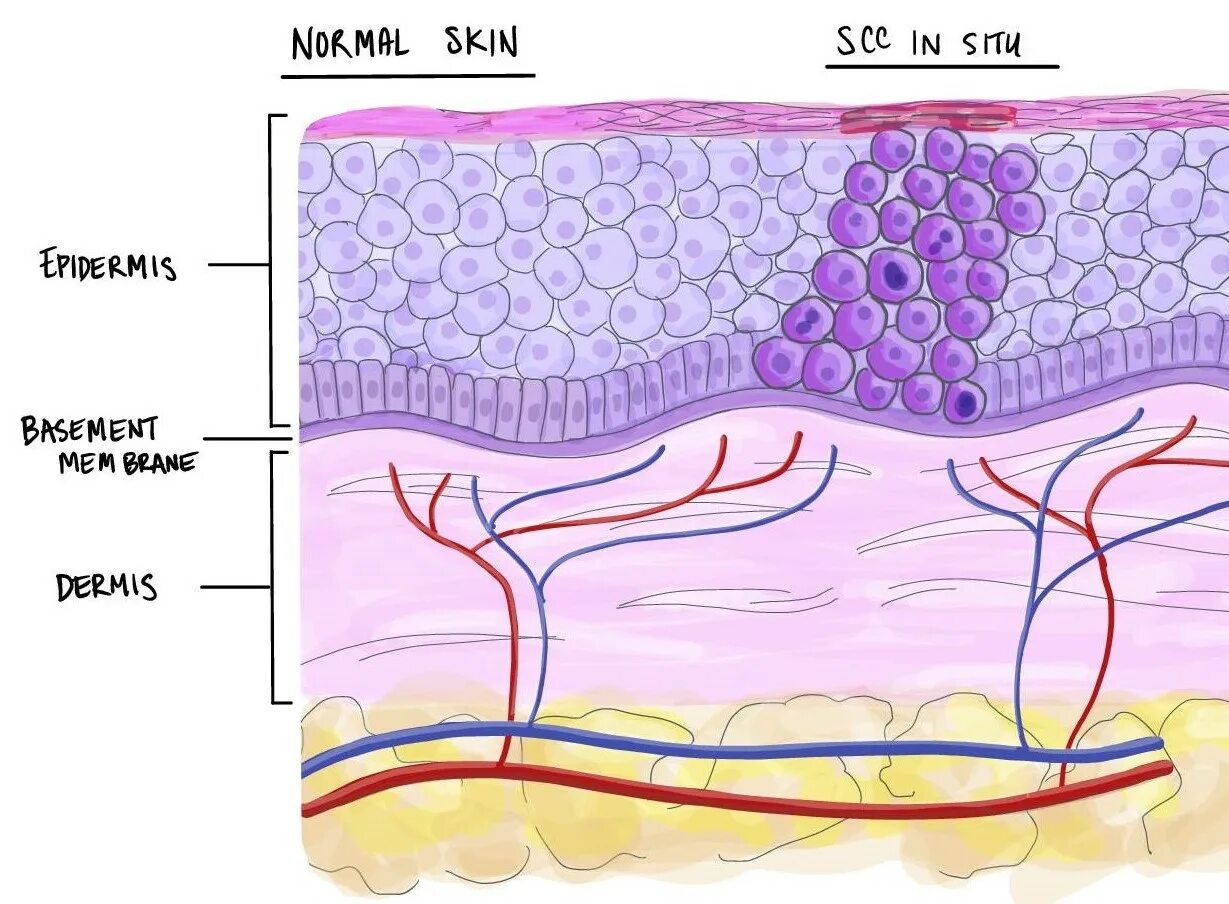 Squamous Cell carcinoma гистология. Плоскоклеточная карцинома кожи. Рак in situ шейки