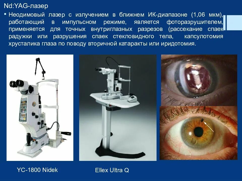 Лазеры в офтальмологии. Yag laser офтальмология. иаг - лазеры применяются в офтальмологии для:. лазерное излучение в офтальмологии. лазер в медицине зрение.